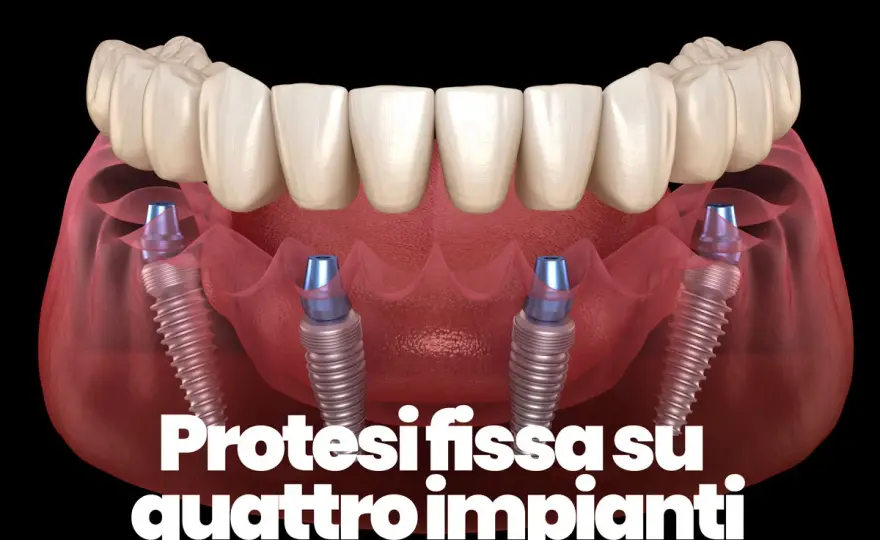 Quattro denti e impianti dentali - quali opzioni hai?