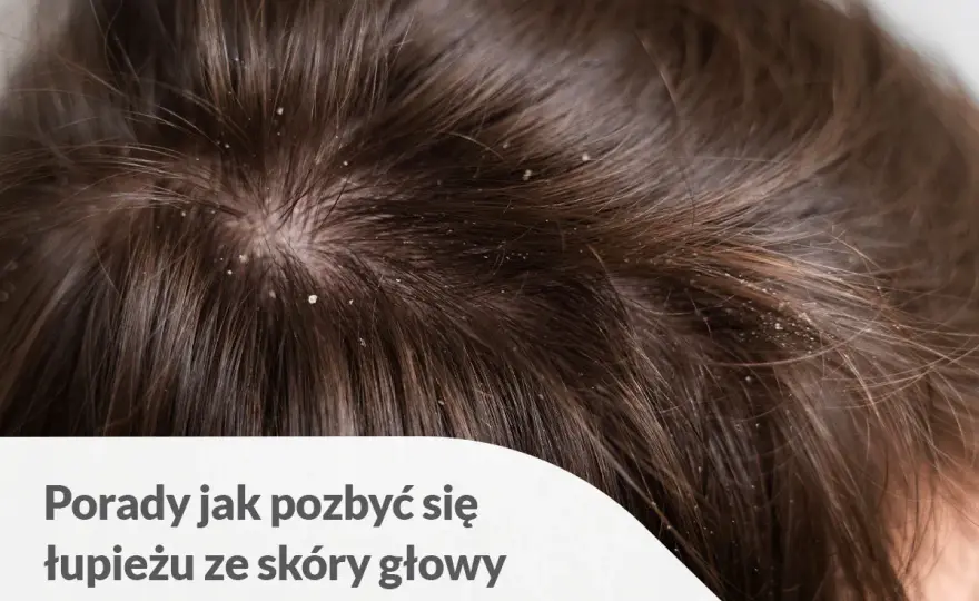Łupież - Jak się go pozbyć? Skuteczne metody i plan działania