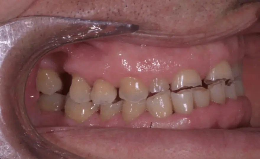 Erosione dentale - Riconoscila e rallentala