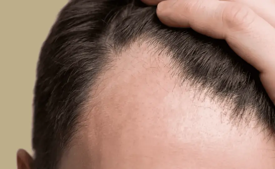 Geheimratsecken - Normal oder Haarausfall? Dein Guide