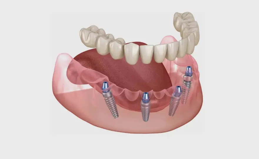 Impianti dentali senza bucare l'osso - cosa è davvero possibile?