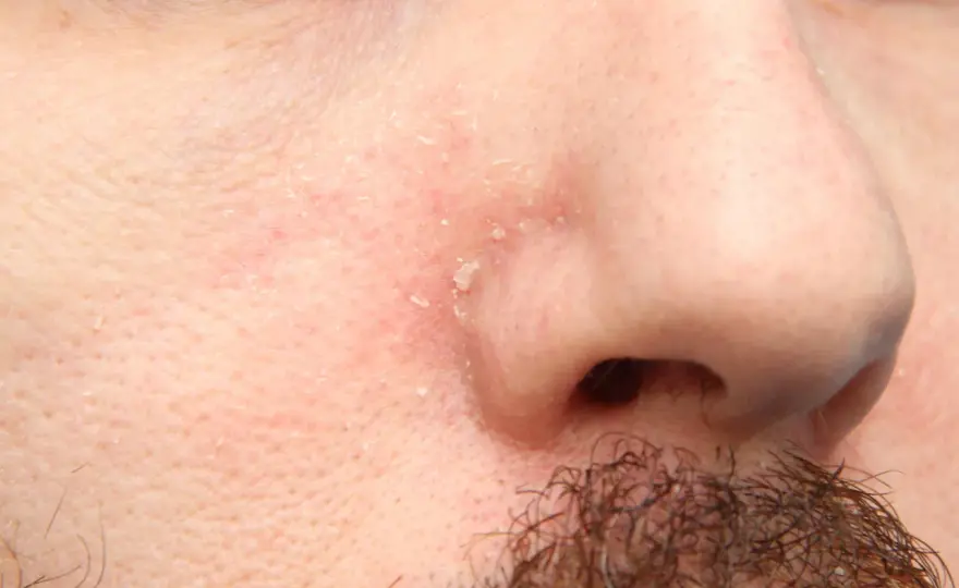 Dermatitis seborreica en la barba - cómo calmarla sin irritar