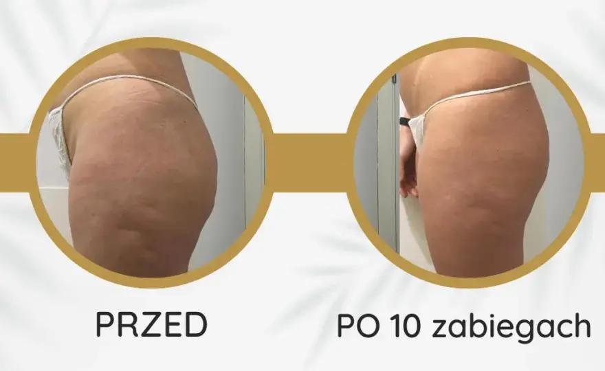 Endermologia: Gładka skóra bez cellulitu? Poznaj efekty i fakty