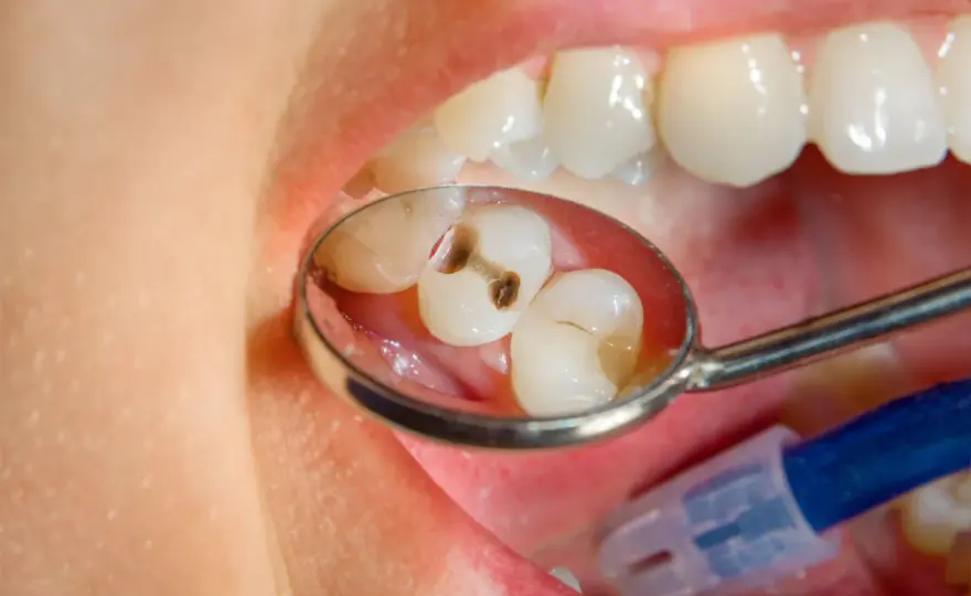 Carie dentale, segnali, cure e prevenzione