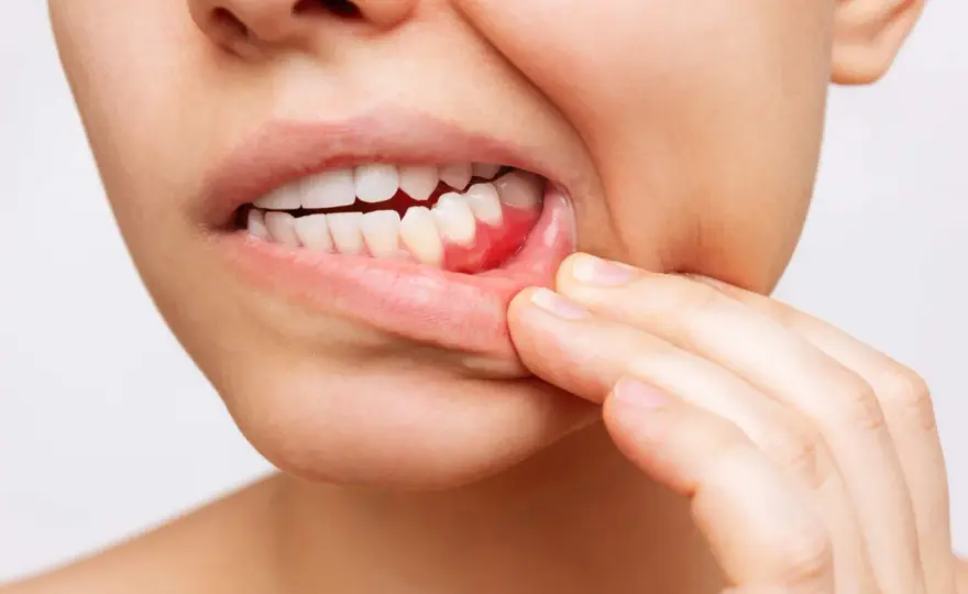 Piorrea o periodontitis - cómo reconocerla y conservar tus dientes