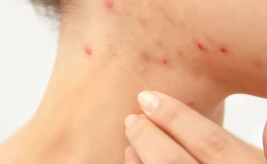 Cortisol-Akne - Was wirklich hilft & wann zum Arzt?