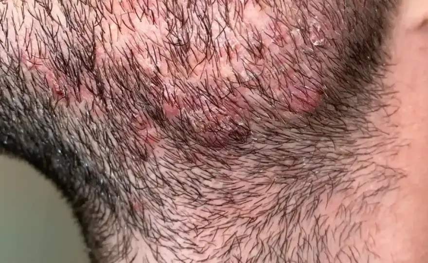 Pickel am Kopf - Ursachen, Hilfe & wann zum Arzt?