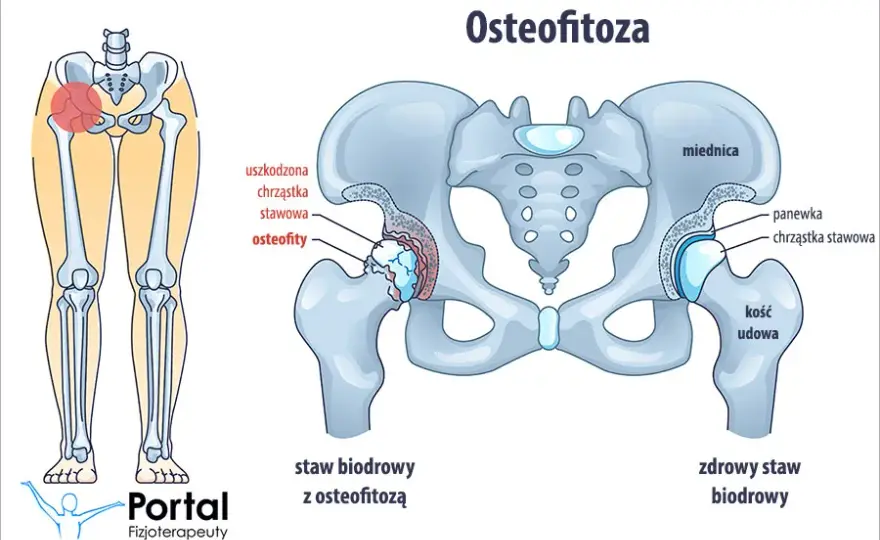 Osteofitoza: Jaka rehabilitacja? Odzyskaj sprawność i zwalcz ból!
