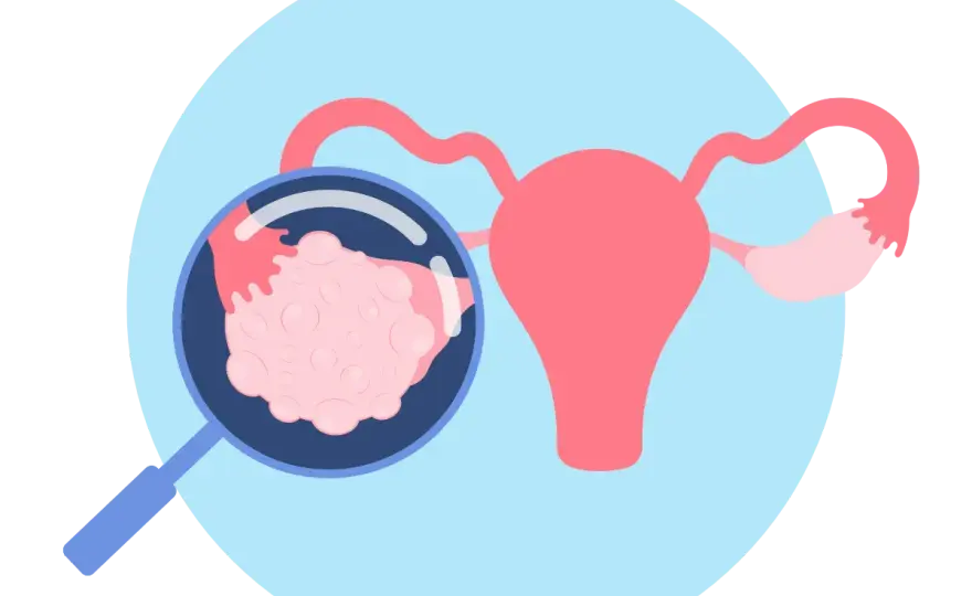 PCOS - Czy to tylko jajniki? Objawy, diagnostyka, leczenie