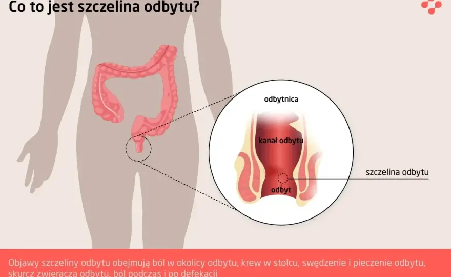 Szczelina odbytu - objawy, leczenie i kiedy do lekarza?
