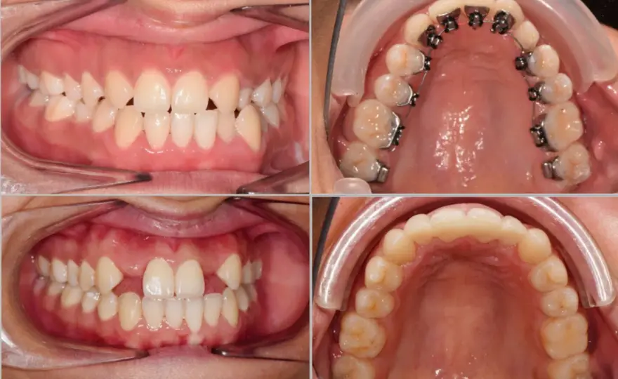 Agenesia dentale - Soluzioni e gestione a ogni età