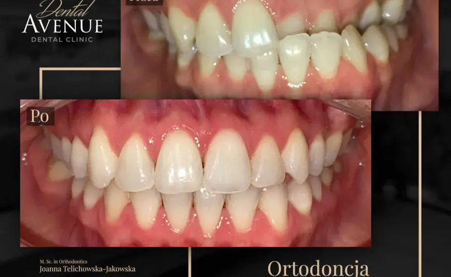 Metamorfoza ortodontyczna - Jak ocenić efekt leczenia?