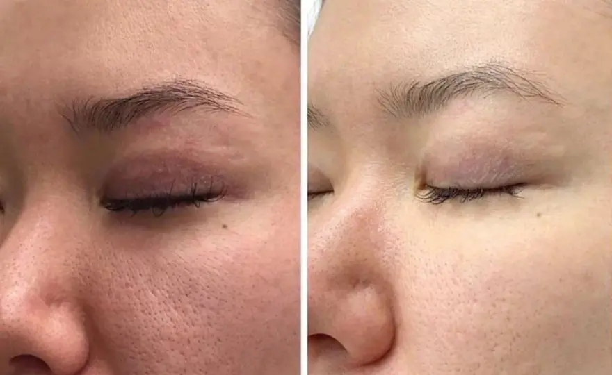 Retinol Vorher Nachher - Was ist realistisch?