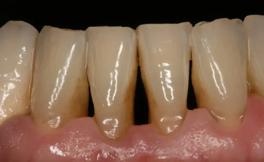 Periodontitis - por qué aparece y cómo evitar que avance