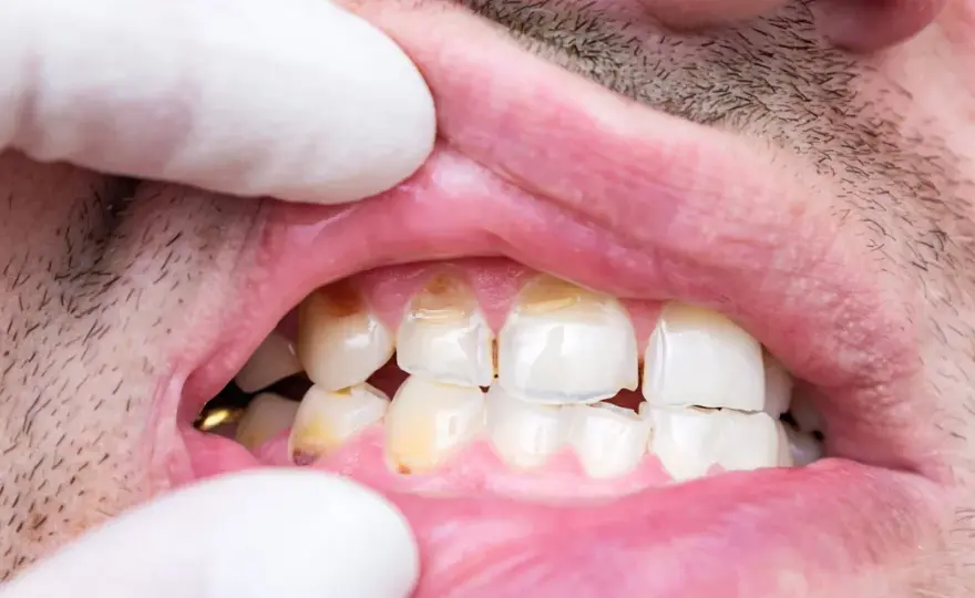 Hipoplasia dental - señales, causas y tratamientos para protegerlo
