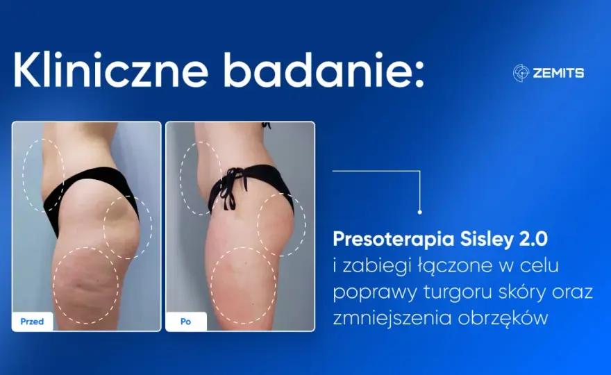 Presoterapia - efekty, ile zabiegów? Cała prawda o drenażu!