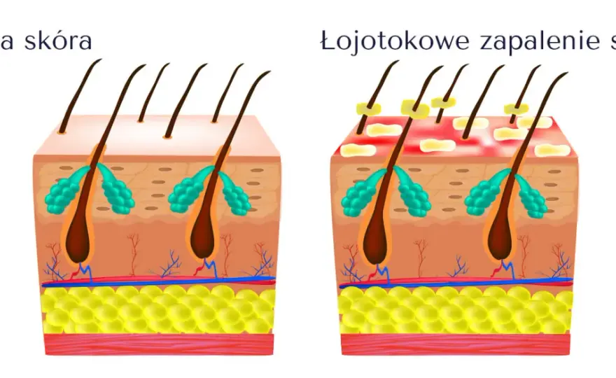 Łojotokowe zapalenie skóry głowy - Jak powstrzymać wypadanie włosów?