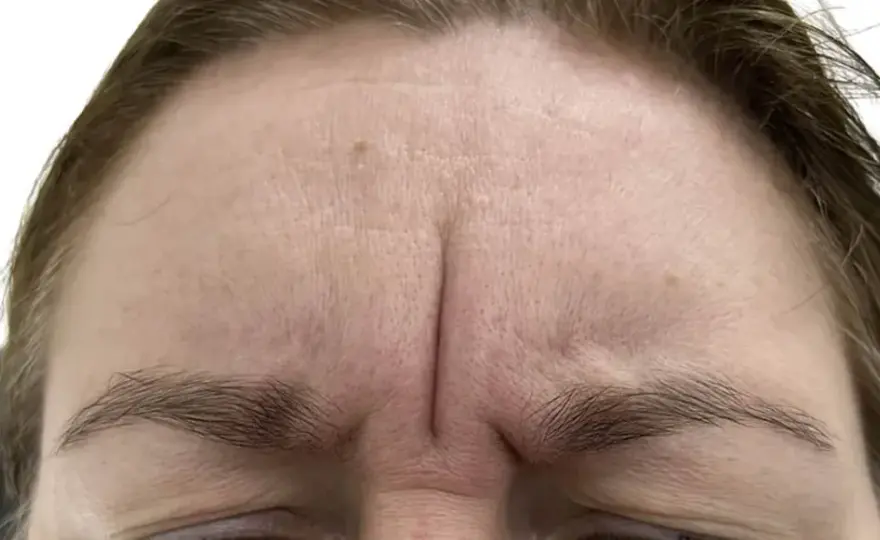 Gdzie kupić botox Allergan? Sprawdzone miejsca i ważne informacje