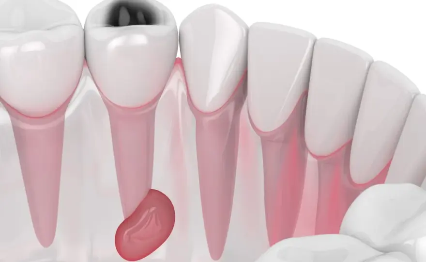 Ascesso gengivale - rimedi sicuri e quando andare dal dentista