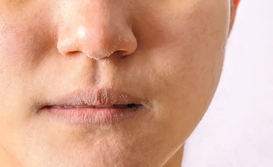 Periorale Dermatitis am Kinn richtig erkennen und beruhigen