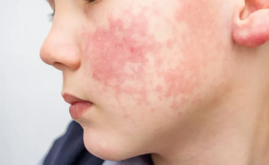 Dermatite atopique et transpiration - les bons gestes