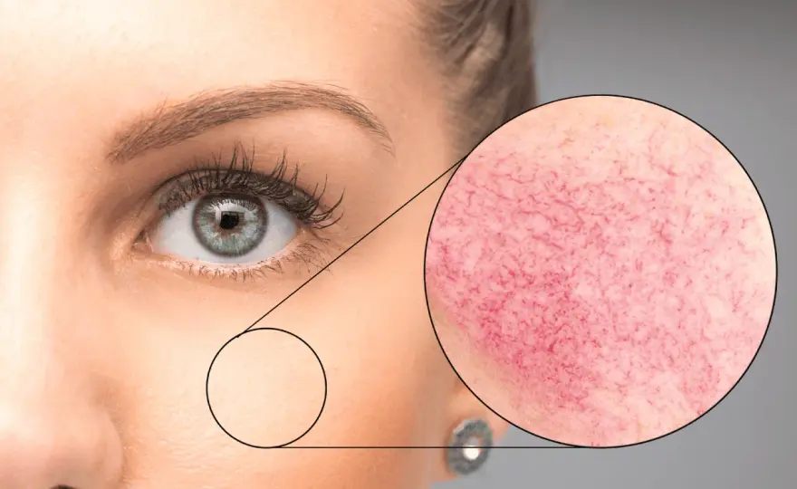 Demodex en la cara - ¿Qué es y cómo controlarlo?