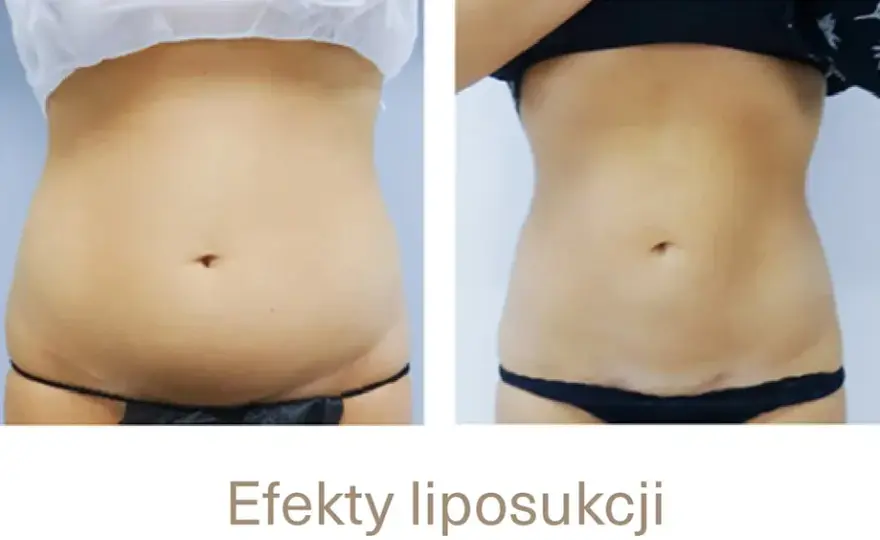 Po liposukcji tłuszcz wraca? Nie! Jak utrzymać nową sylwetkę