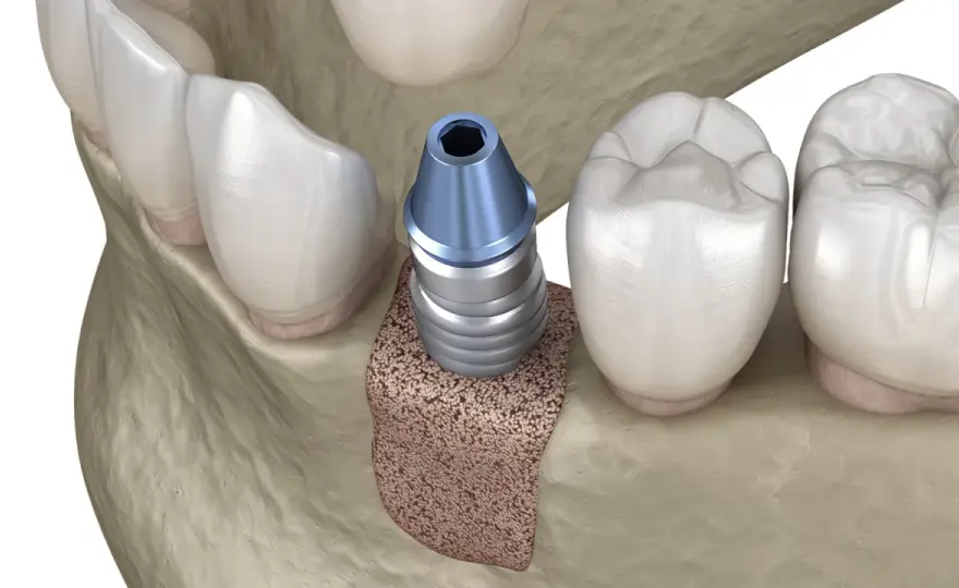 Innesto osseo autologo: la soluzione definitiva per impianti dentali?