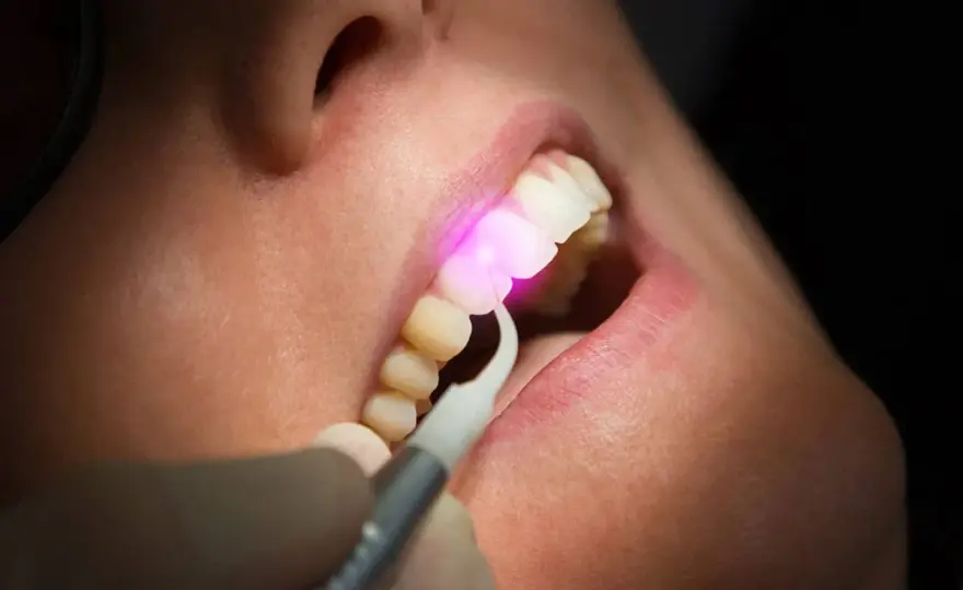 Laser alle gengive - quando serve davvero e quanto costa