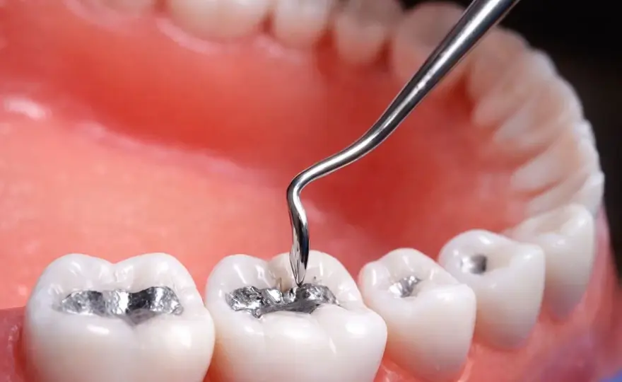 Amalgama dental - riesgos, alternativas y cuándo cambiarla