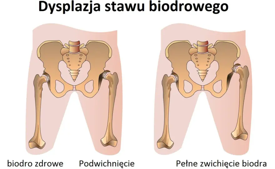 Zwyrodnienie biodra - Objawy, leczenie i kiedy operacja?