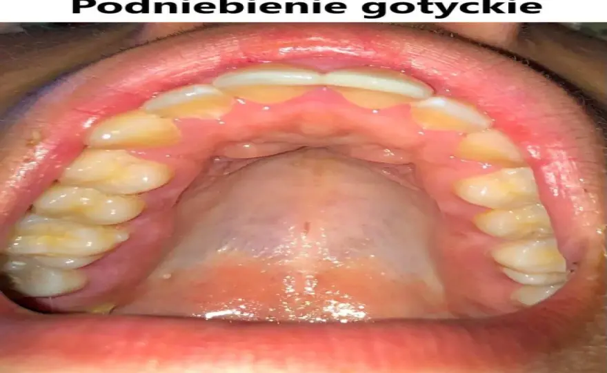 Podniebienie gotyckie - cecha czy problem? Kiedy leczyć?