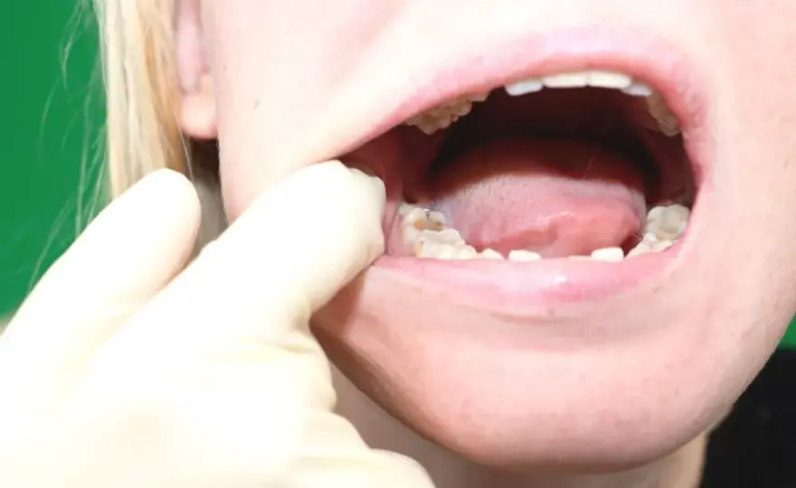 Ból zęba mądrości (ósemki): Szybka ulga i kiedy do dentysty?
