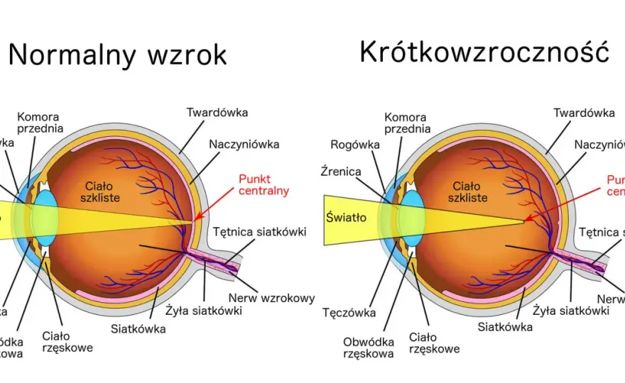 Krótkowzroczność - Co robić, gdy dalekie obrazy tracą ostrość?