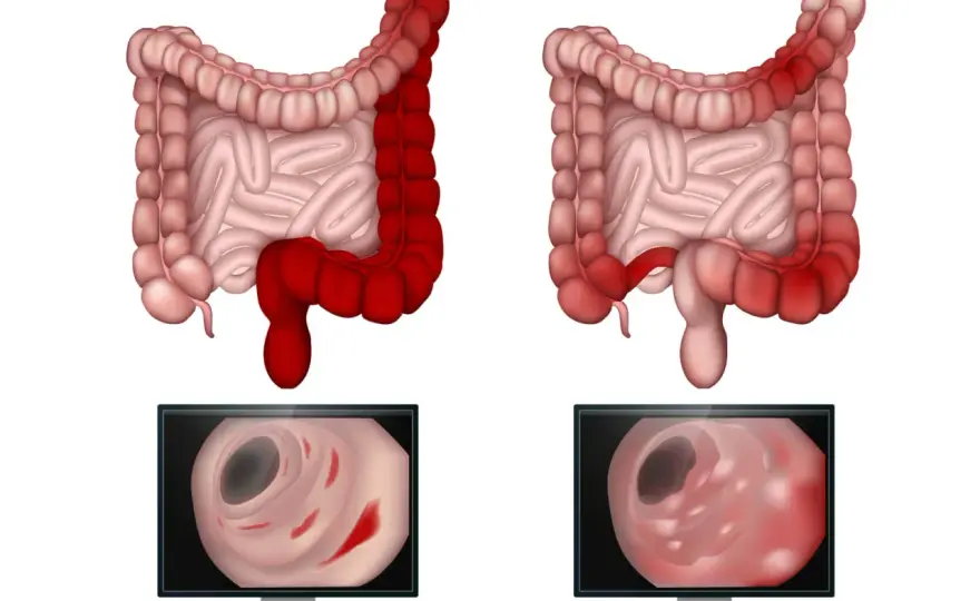 Morbus Crohn Symptome: Erkennen Sie die alarmierenden Anzeichen