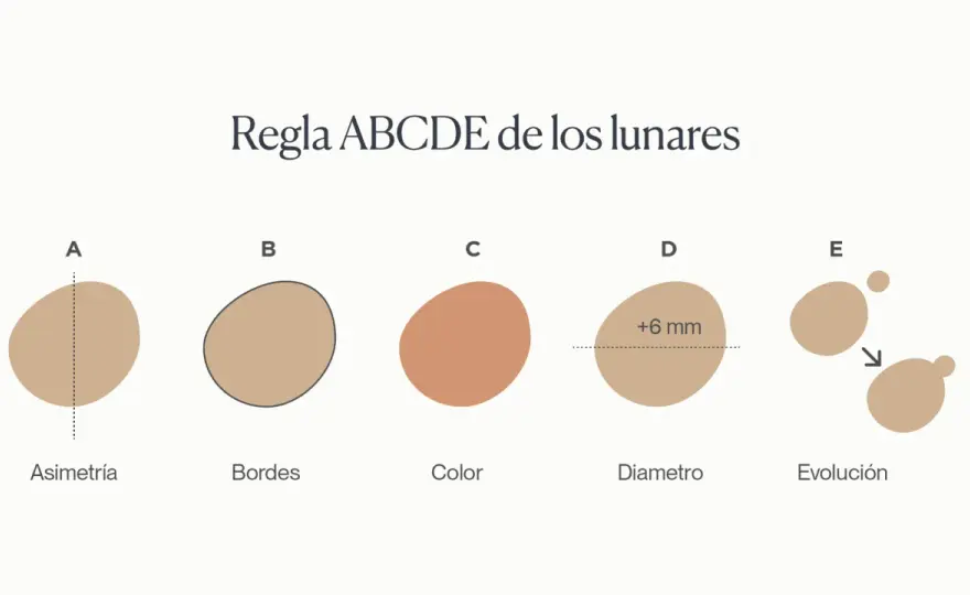 Lunares malignos - Cómo detectarlos a tempo con la regla ABCDE