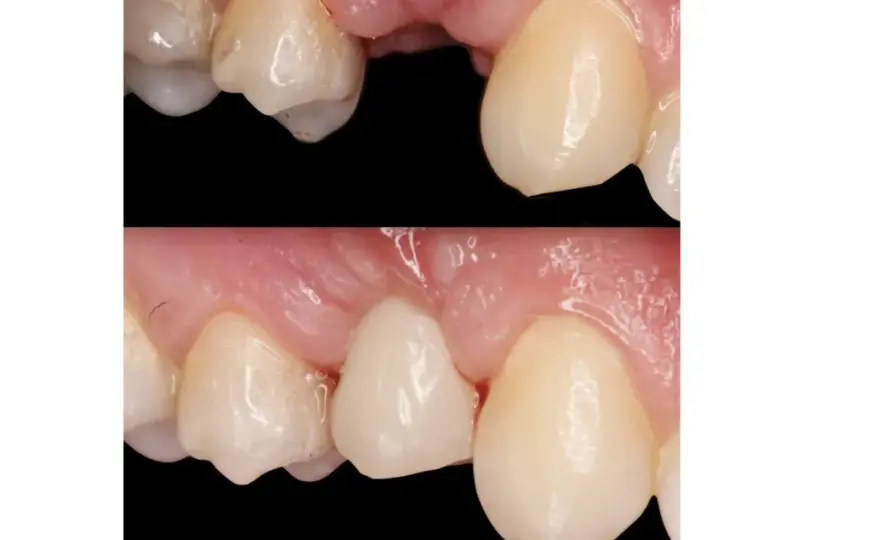 Ponte Maryland, quali svantaggi e quando conviene?