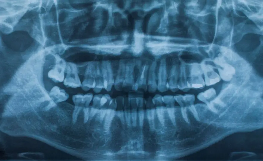 Traumatismo dental - qué hacer para conservar el diente