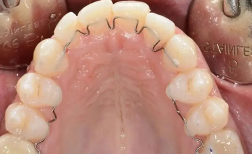 Dente cariato - Capisci, curati, risparmia!