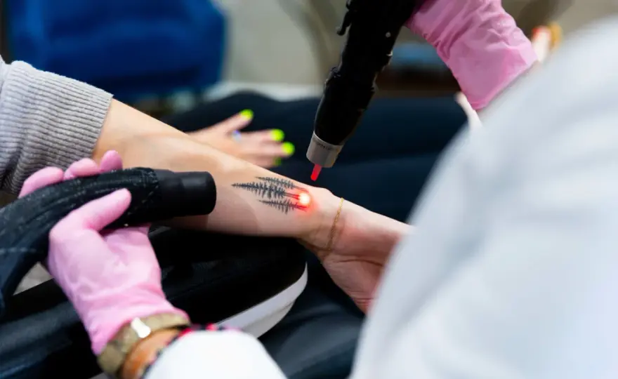 Tatueringsborttagning med laser - så går det till och vad det kostar