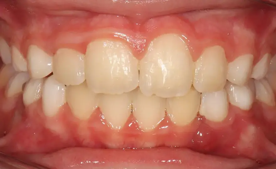 Evolución de Invisalign mes a mes - qué esperar en cada etapa