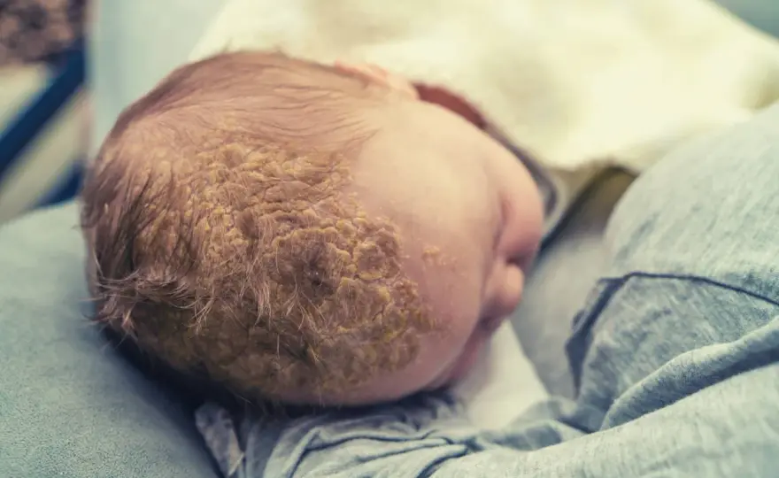 Crosta lattea nel neonato - come gestirla e quando sentire il pediatra