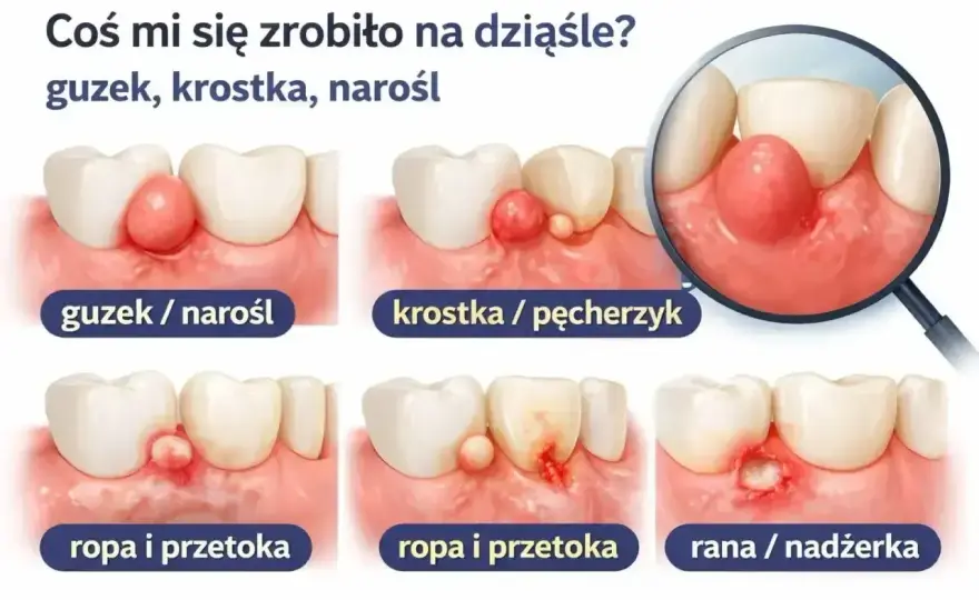 Bąbel na dziąśle - afta, ropień czy przetoka?