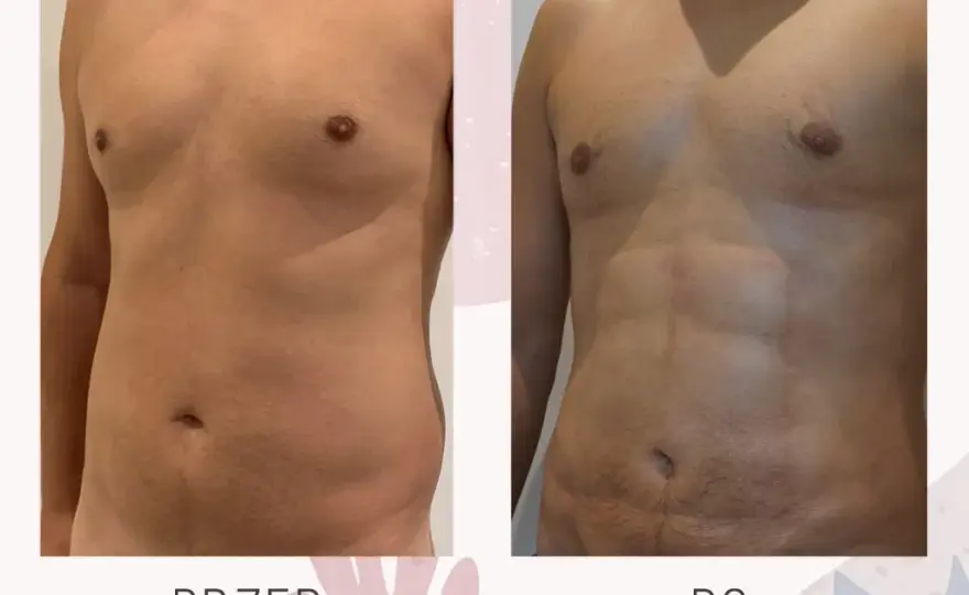 Ile kosztuje zabieg liposukcji? Sprawdź ceny i ukryte koszty