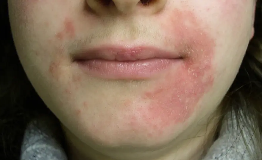 Perioral dermatit runt munnen - Så lugnar du huden effektivt