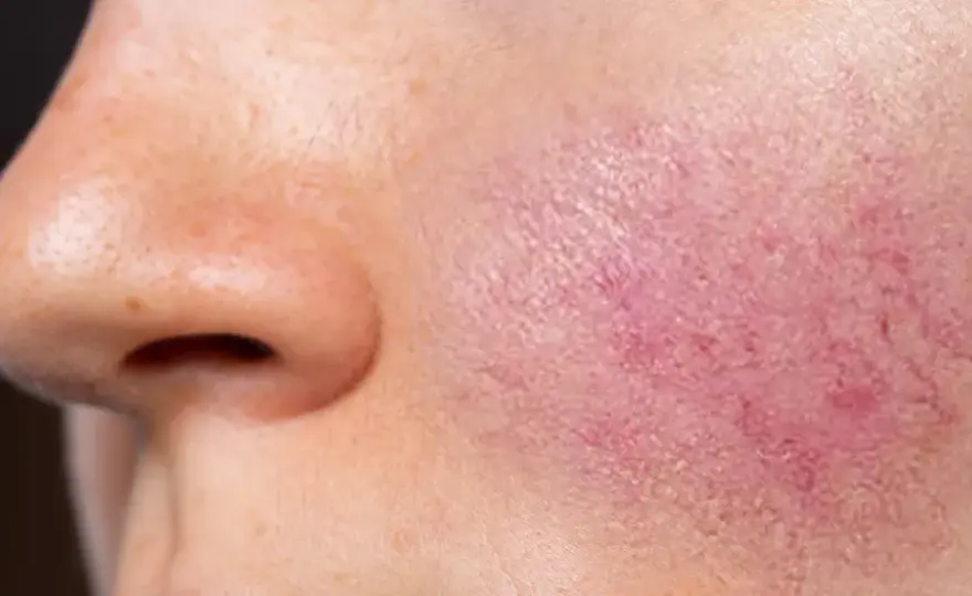 Rojeces en la cara - ¿Rosácea, dermatitis o irritación?