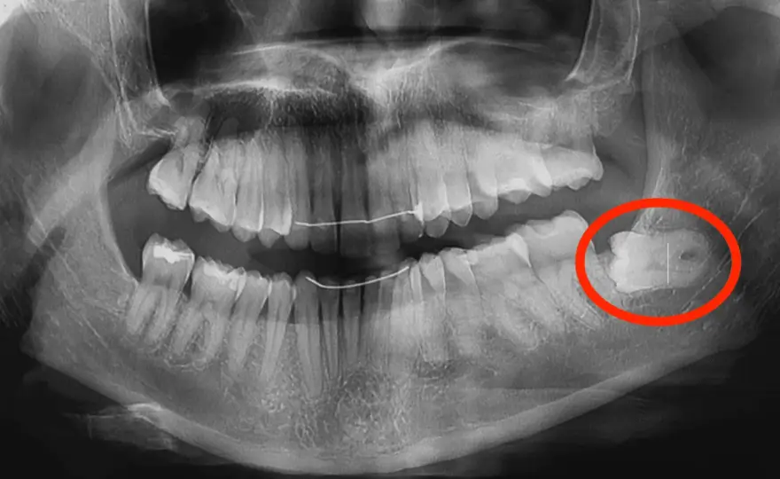 Togliere una carie fa male? La verità e cosa aspettarsi