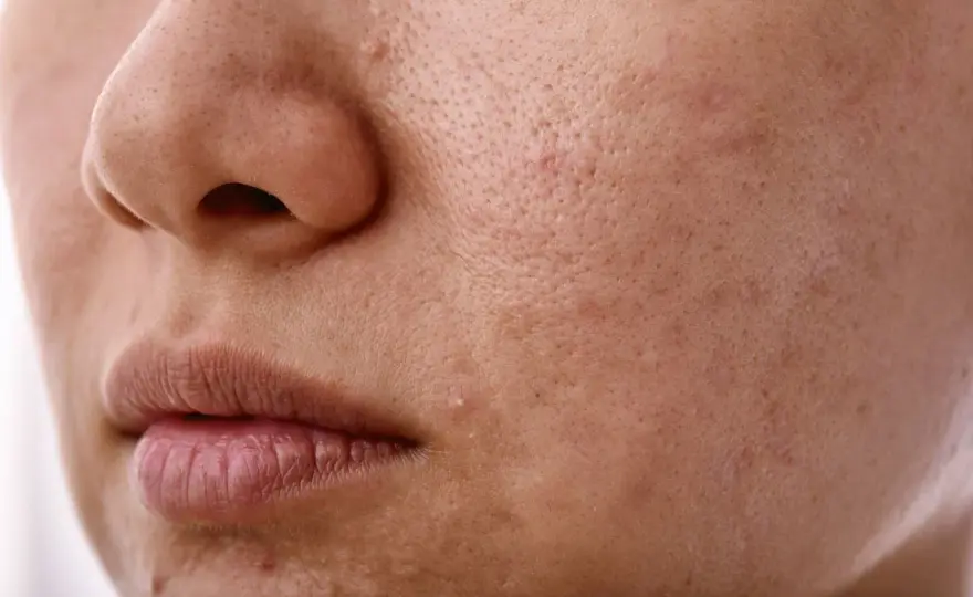 Sebum na twarzy - jak regulować nadmiar łoju i błyszczenie skóry?