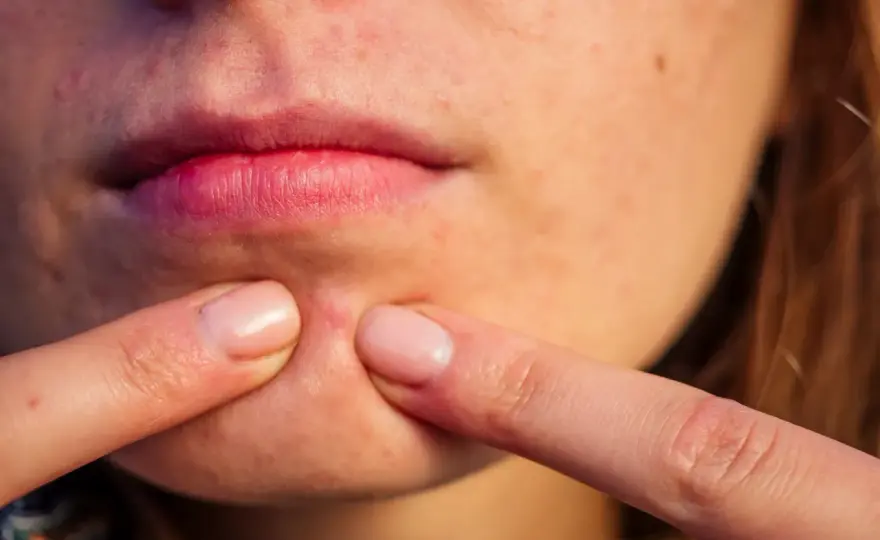 Espinilla inflamada: ¿Qué hacer y cuándo ir al dermatólogo?
