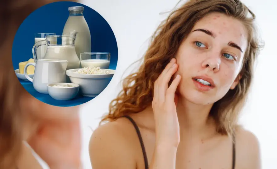 Nabiał a trądzik - Czy mleko szkodzi cerze? Sprawdź!